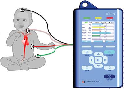 Thoracic Fluid Content (TFC) Measurement Using Impedance Cardiography Predicts Outcomes in Critically Ill Children